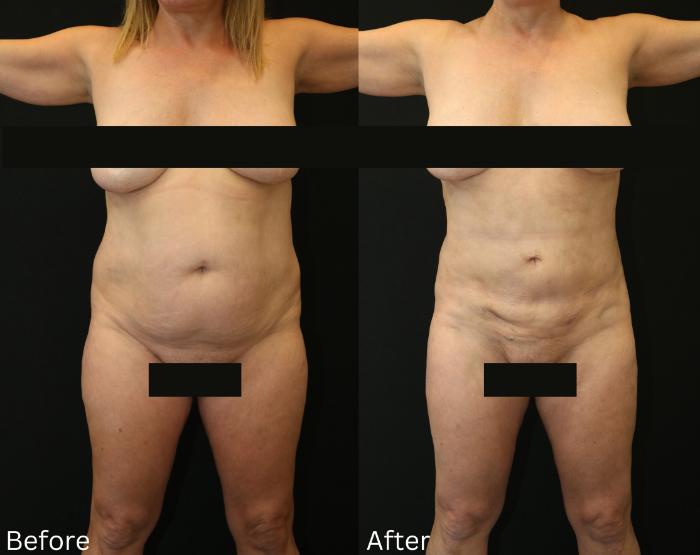 Before & After Liposuction Case 78 View 1 View in Santa Rosa, California