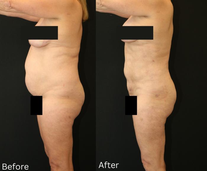 Before & After Liposuction Case 78 View 2 View in Santa Rosa, California
