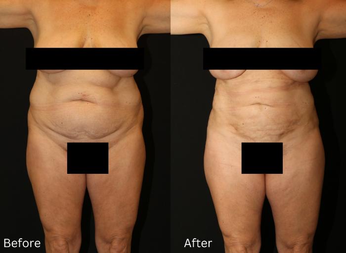 Before & After Liposuction Case 79 View 1 View in Santa Rosa, California