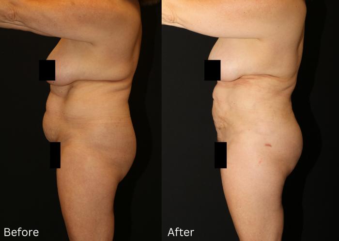 Before & After Liposuction Case 79 View 2 View in Santa Rosa, California