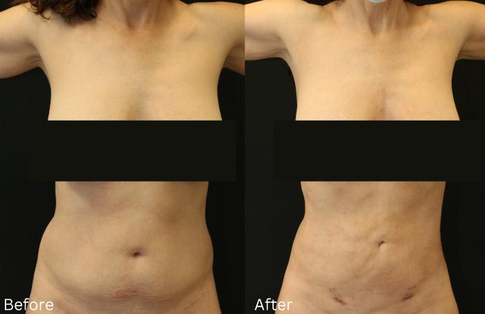 Before & After Liposuction Case 80 View 1 View in Santa Rosa, California