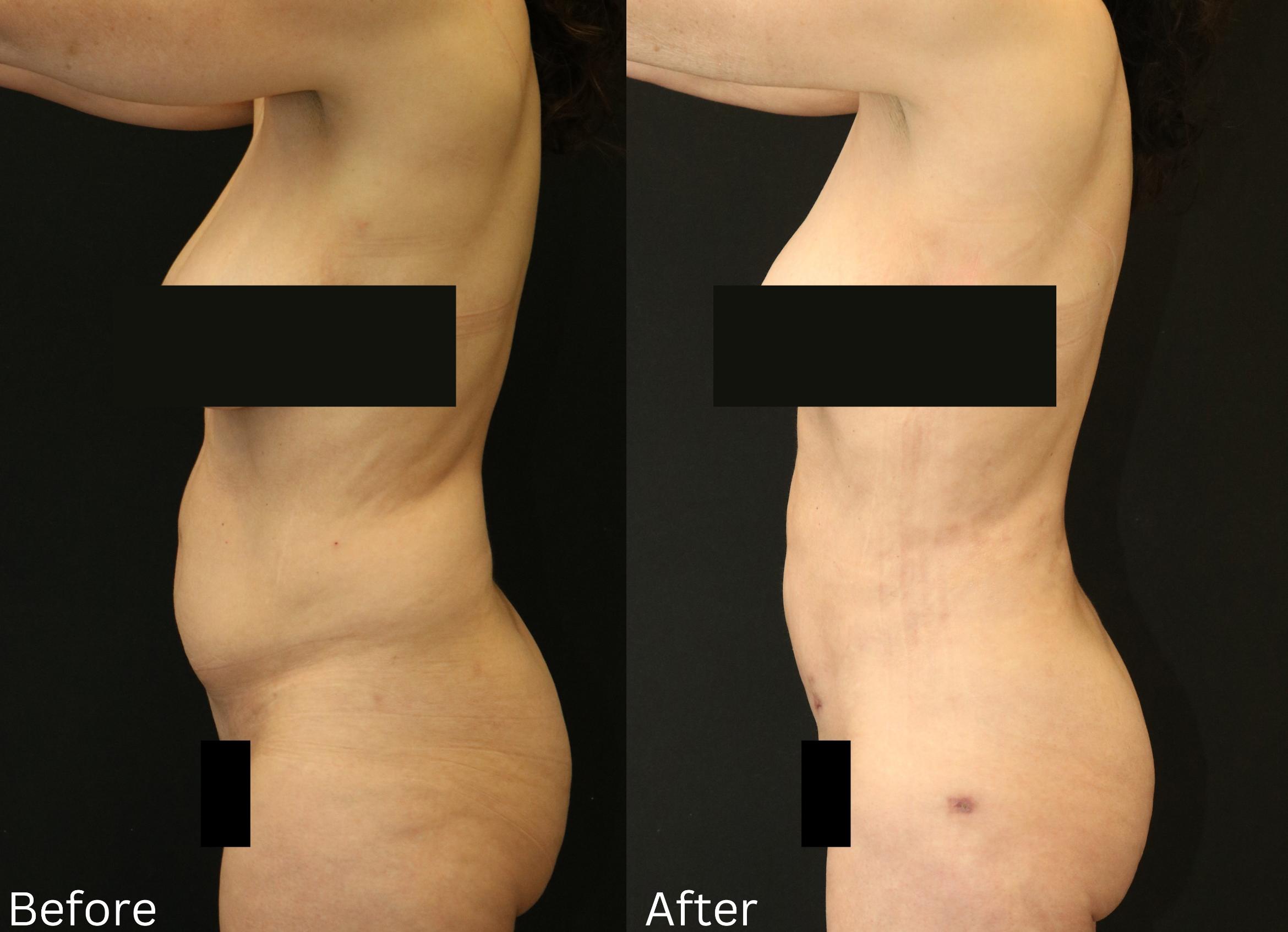 Before & After Liposuction Case 80 View 2 View in Santa Rosa, California