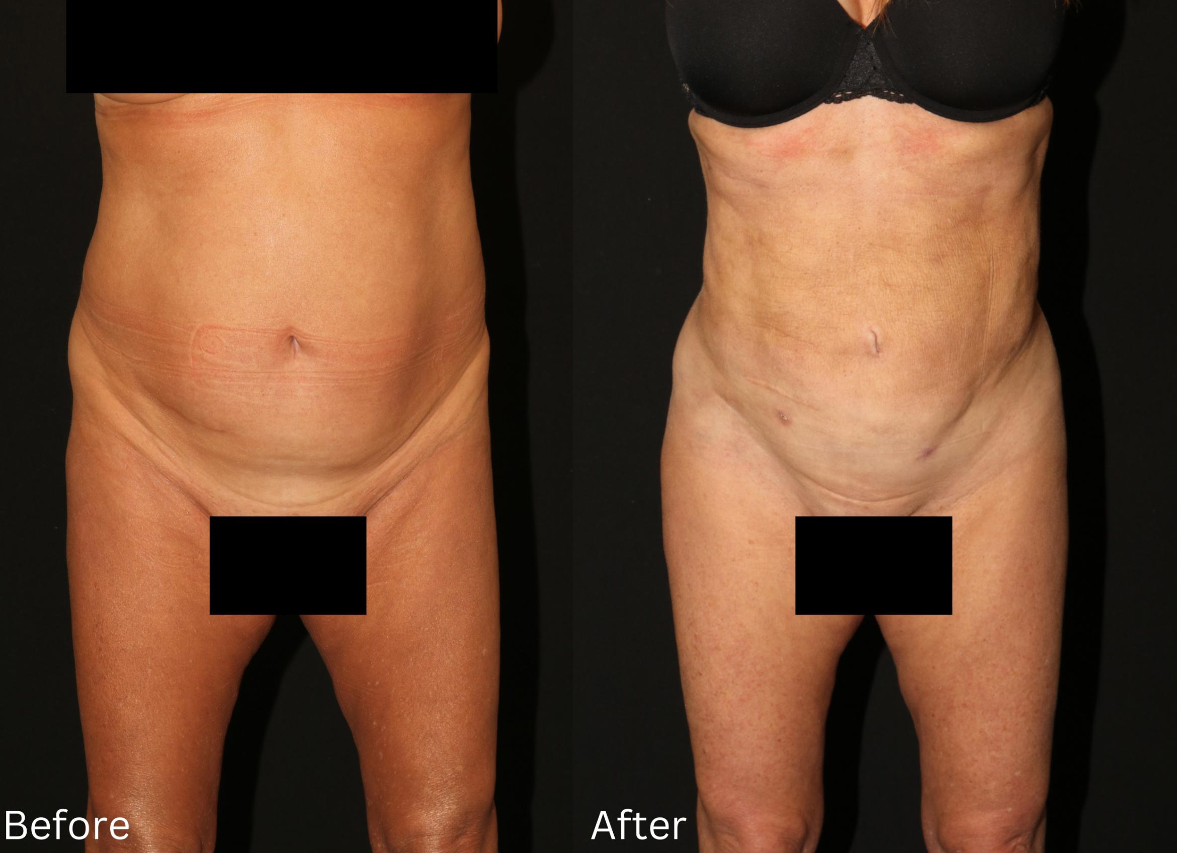 Before & After Liposuction Case 81 View 1 View in Santa Rosa, California