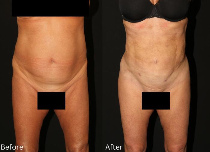 Before & After Liposuction Case 81 View 1 View in Santa Rosa, California