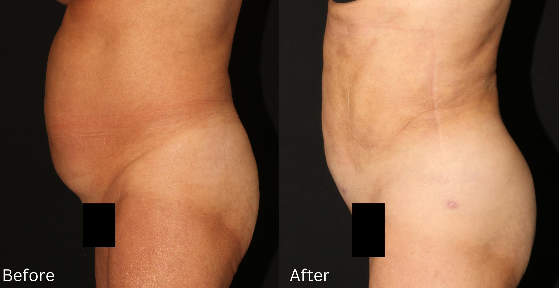 Before & After Liposuction Case 81 View 2 View in Santa Rosa, California