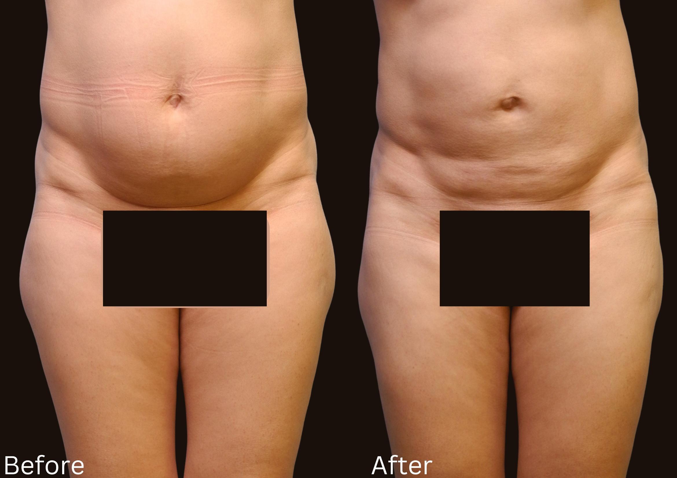 Before & After Liposuction Case 82 View 1 View in Santa Rosa, California