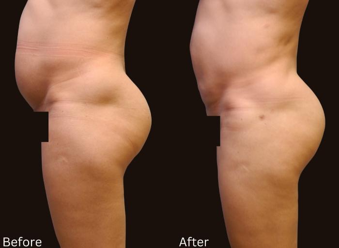 Before & After Liposuction Case 82 View 2 View in Santa Rosa, California