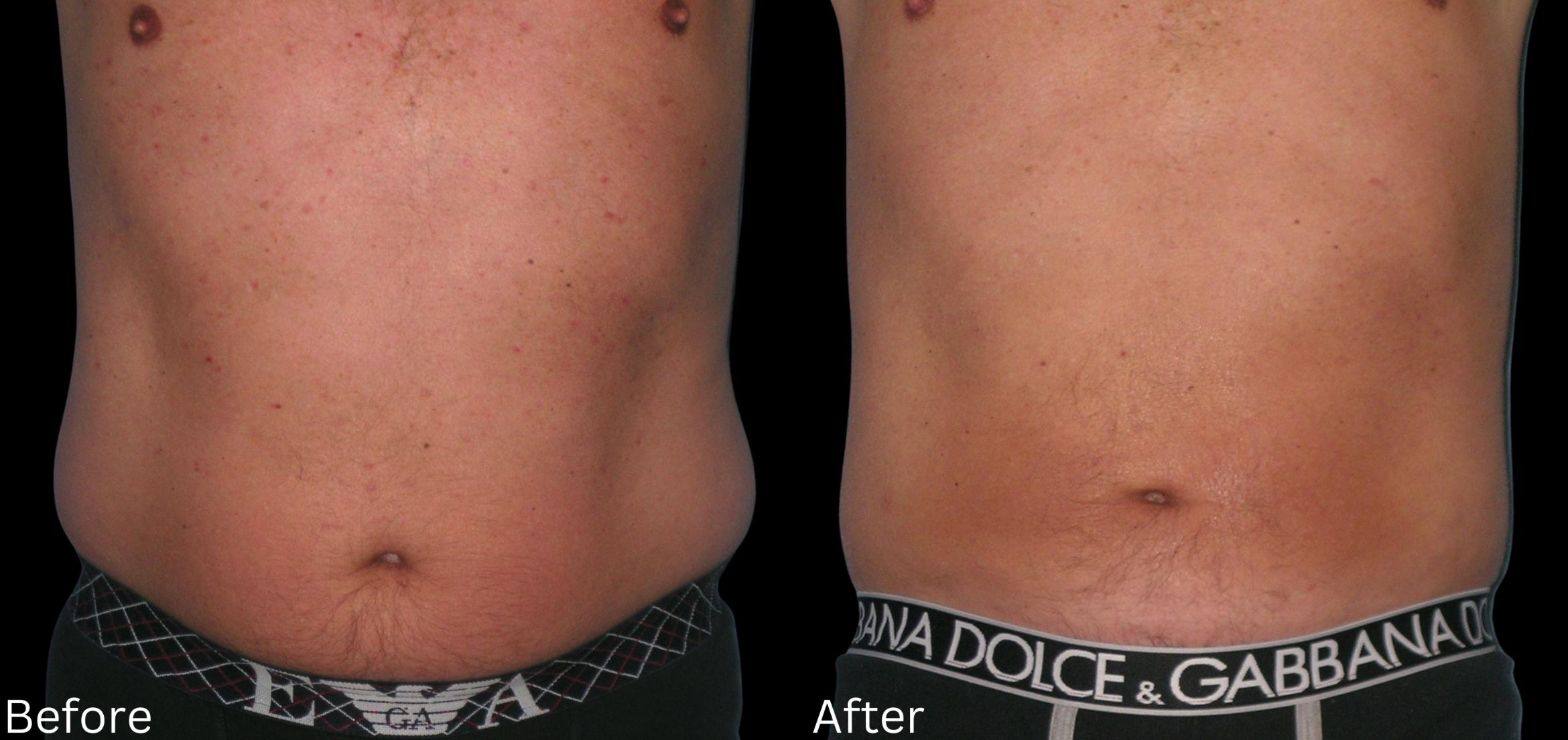 Before & After Liposuction Case 83 View 1 View in Santa Rosa, California