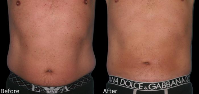 Before & After Liposuction Case 83 View 1 View in Santa Rosa, California