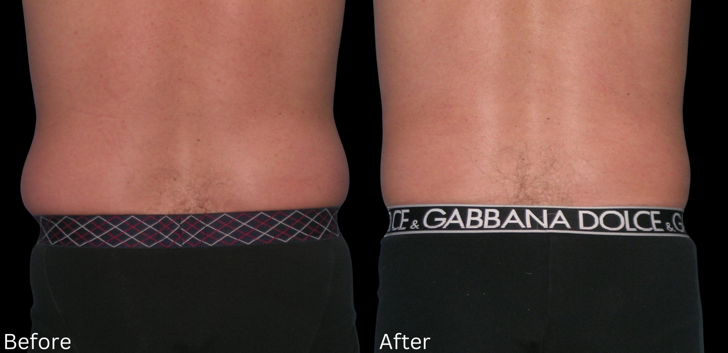 Before & After Liposuction Case 83 View 2 View in Santa Rosa, California