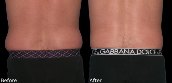 Before & After Liposuction Case 83 View 2 View in Santa Rosa, California