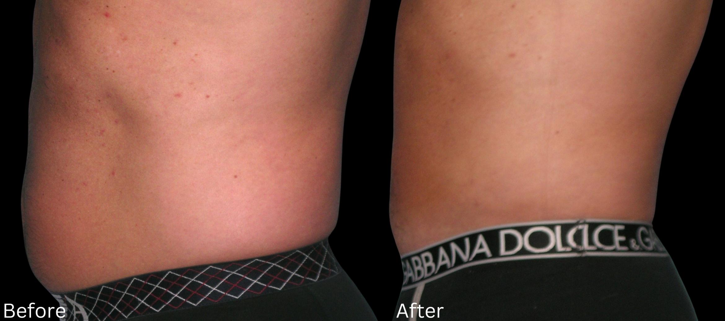 Before & After Liposuction Case 83 View 3 View in Santa Rosa, California