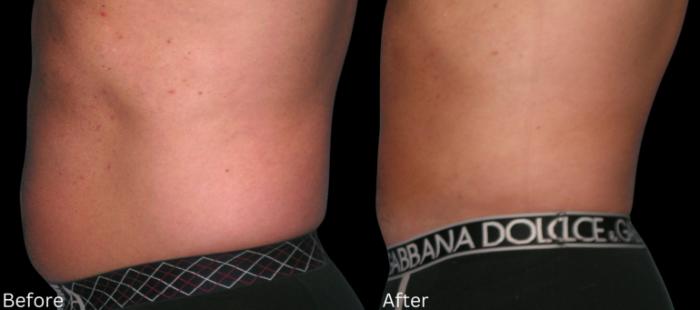 Before & After Liposuction Case 83 View 3 View in Santa Rosa, California