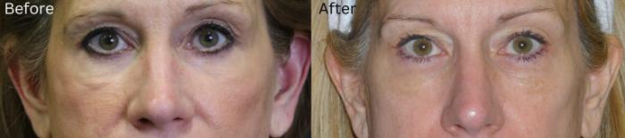 Before & After Malar Festoons Case 292 View 1 View in Santa Rosa, California