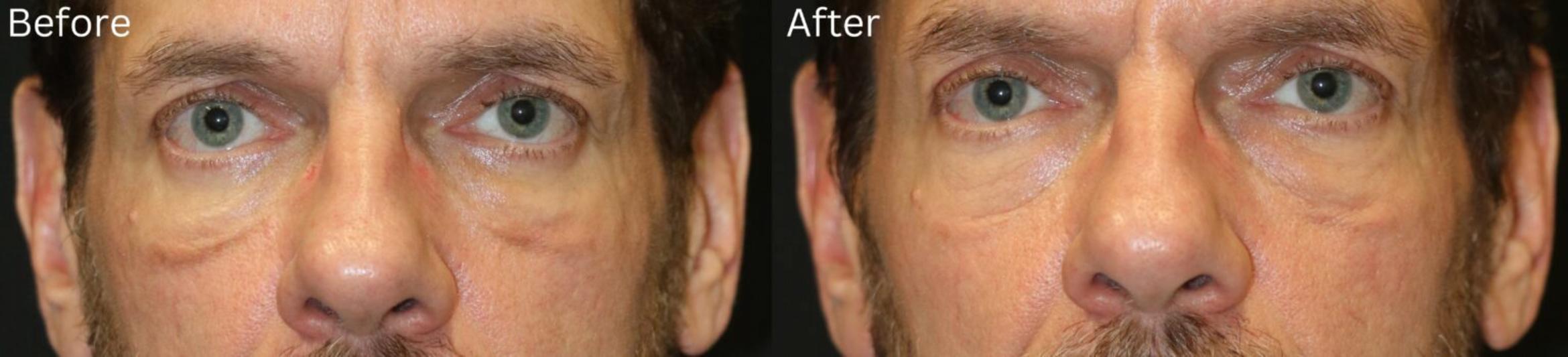 Before & After Malar Festoons Case 293 View 1 View in Santa Rosa, California