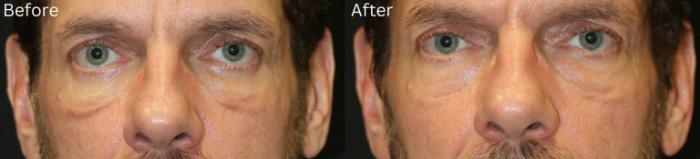 Before & After Malar Festoons Case 293 View 1 View in Santa Rosa, California