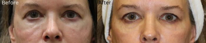 Before & After Malar Festoons Case 294 View 1 View in Santa Rosa, California