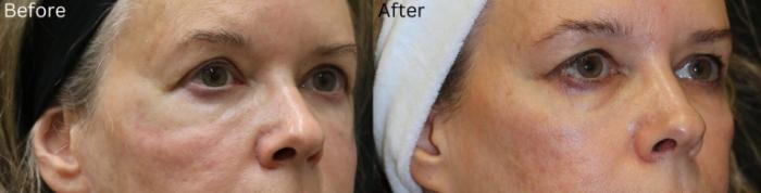 Before & After Malar Festoons Case 294 View 2 View in Santa Rosa, California