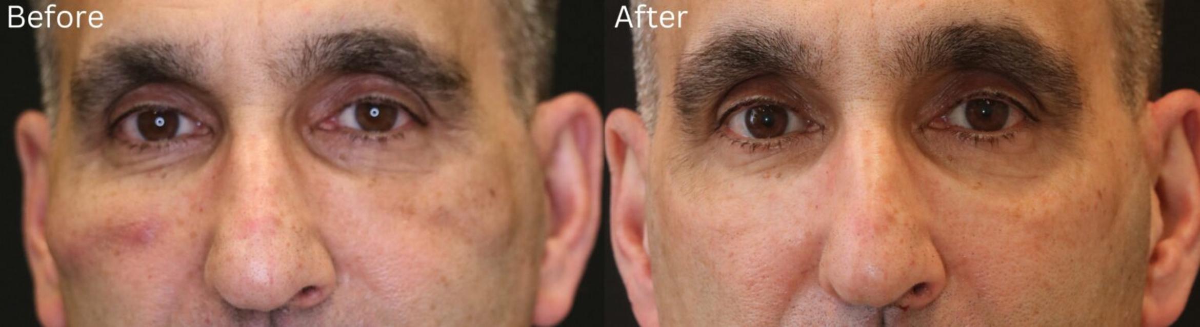 Before & After Malar Festoons Case 295 View 1 View in Santa Rosa, California