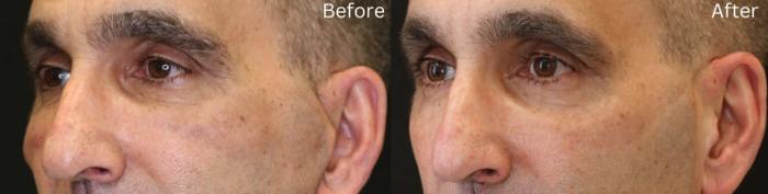 Before & After Malar Festoons Case 295 View 2 View in Santa Rosa, California