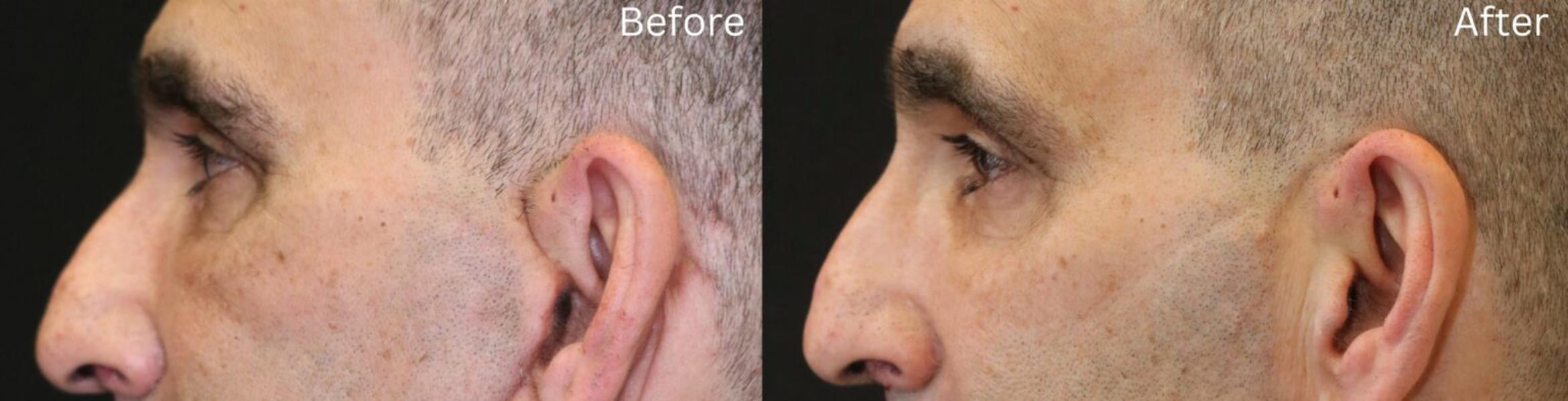 Before & After Malar Festoons Case 295 View 3 View in Santa Rosa, California