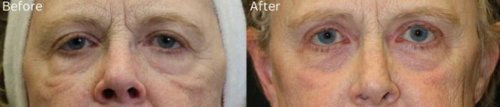 Before & After Malar Festoons Case 296 View 1 View in Santa Rosa, California