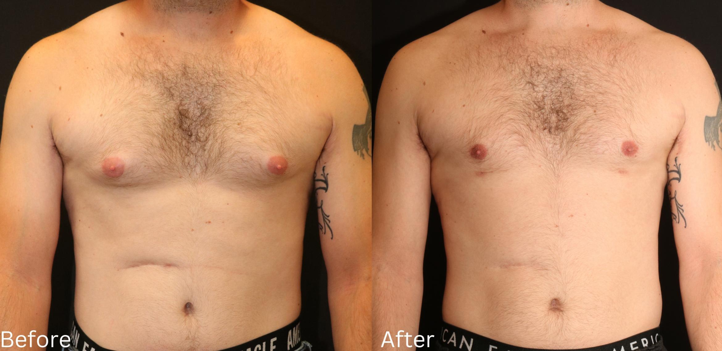 Before & After Male Breast Reduction Case 113 View 1 View in Santa Rosa, California
