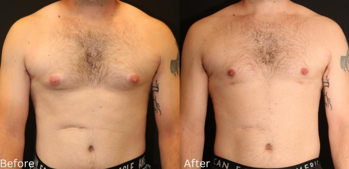 Before & After Male Breast Reduction Case 113 View 1 View in Santa Rosa, California