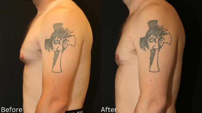 Before & After Male Breast Reduction Case 113 View 2 View in Santa Rosa, California