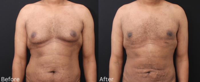 Before & After Male Breast Reduction Case 114 View 1 View in Santa Rosa, California