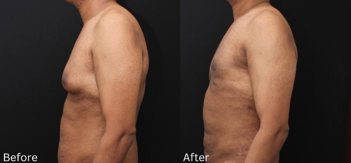 Before & After Male Breast Reduction Case 114 View 2 View in Santa Rosa, California