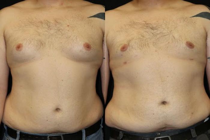 Before & After Male Breast Reduction Case 272 View 1 View in Santa Rosa, California