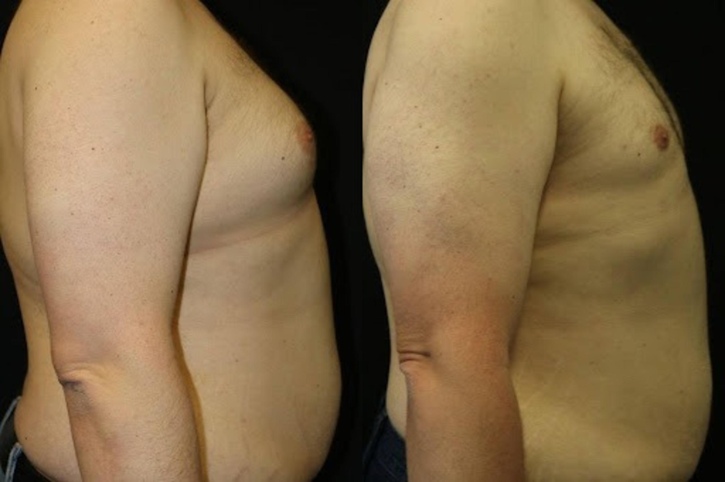 Before & After Male Breast Reduction Case 272 View 2 View in Santa Rosa, California