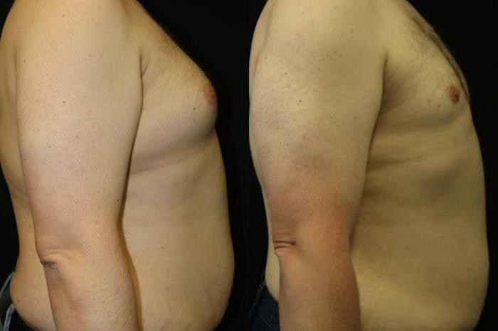 Before & After Male Breast Reduction Case 272 View 2 View in Santa Rosa, California