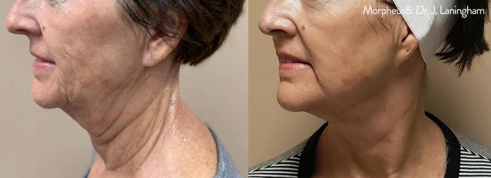 Before & After Morpheus8 Case 250 View 2 View in Santa Rosa, California