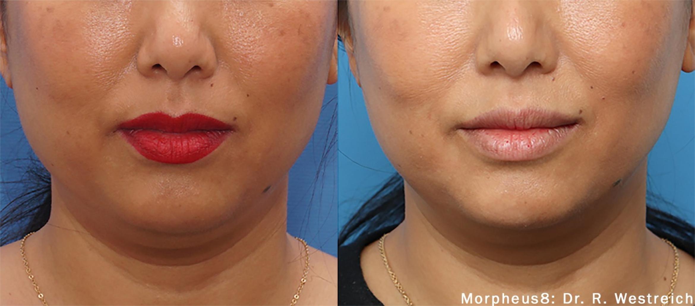 Before & After Morpheus8 Case 254 View 1 View in Santa Rosa, California
