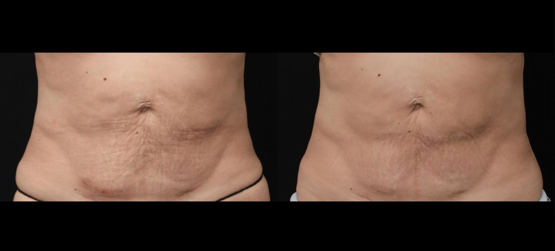Before & After Morpheus8 Case 387 View 1 View in Santa Rosa, California