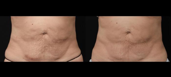 Before & After Morpheus8 Case 387 View 1 View in Santa Rosa, California