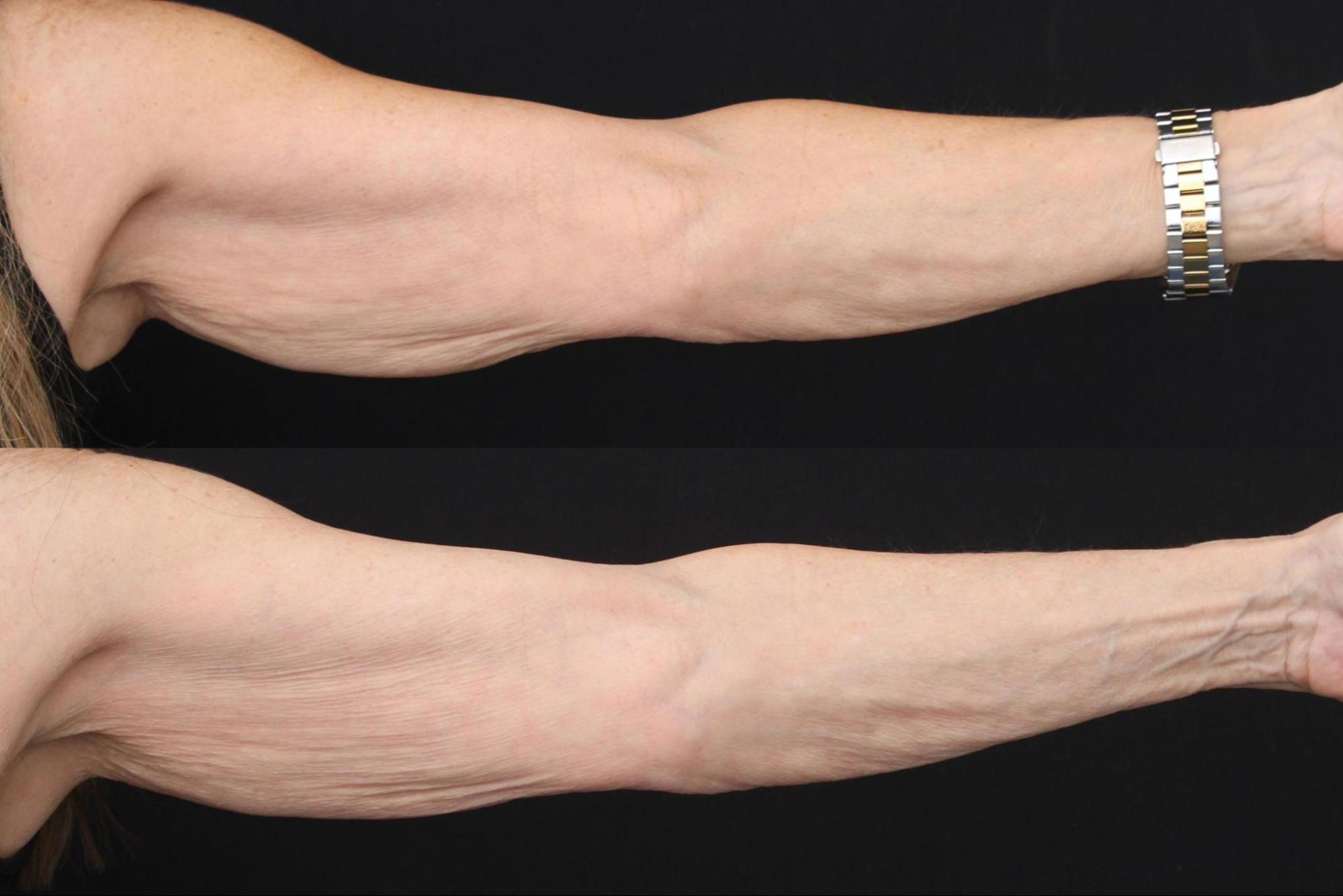 Before & After Morpheus8 Case 388 View 1 View in Santa Rosa, California