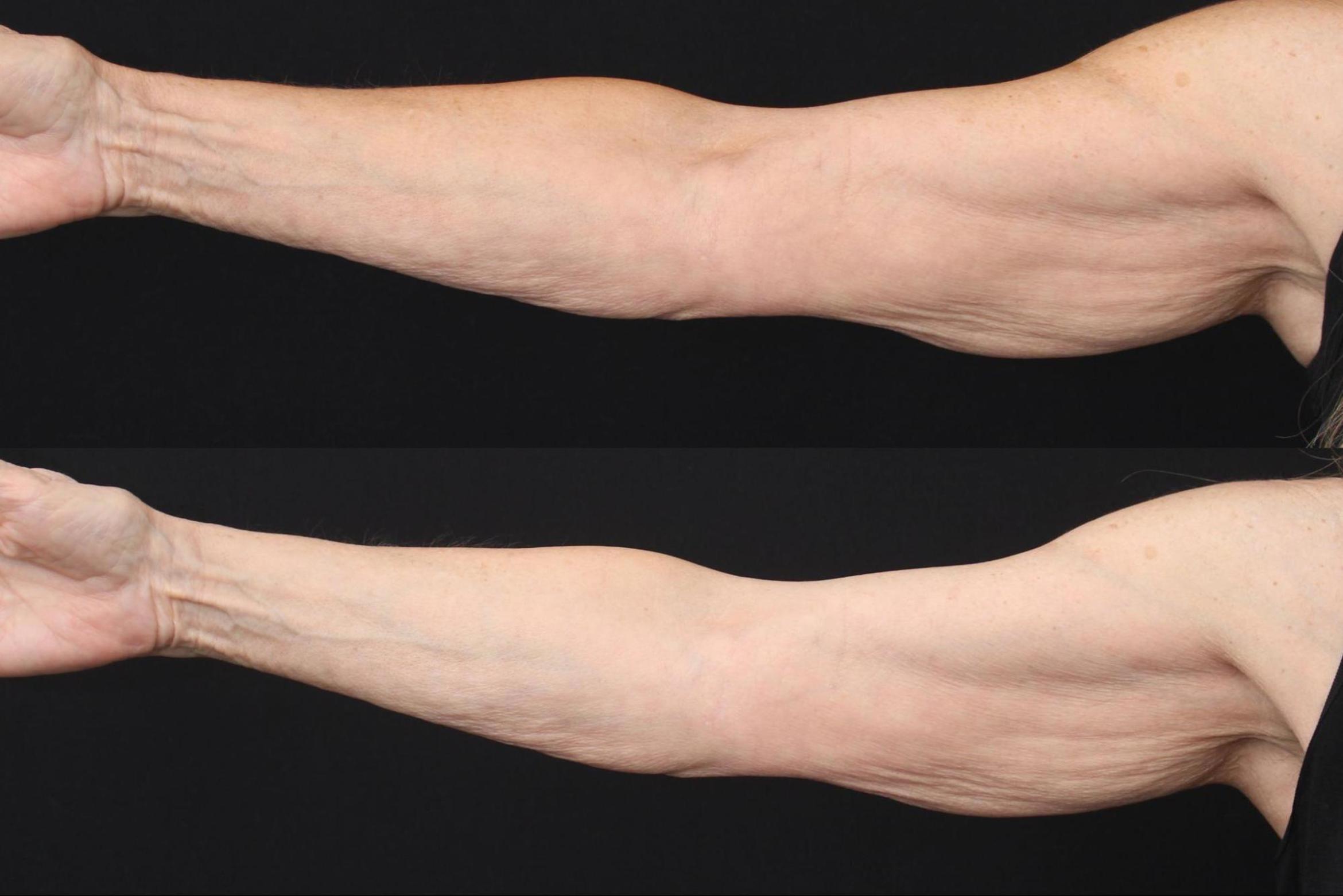 Before & After Morpheus8 Case 388 View 2 View in Santa Rosa, California