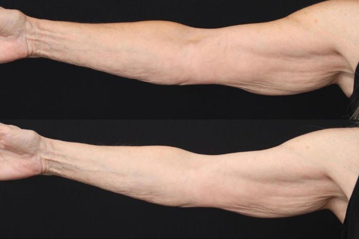 Before & After Morpheus8 Case 388 View 2 View in Santa Rosa, California