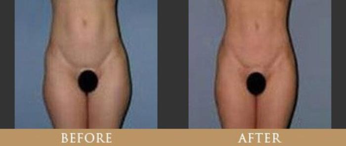 Before & After Morpheus8 Case 7 View 1 View in Santa Rosa, California