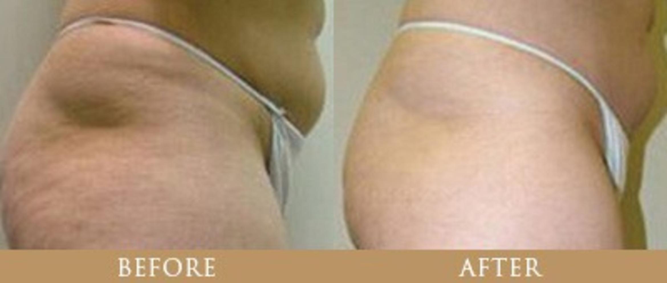 Before & After Morpheus8 Case 90 View 1 View in Santa Rosa, California