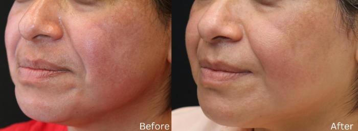 Before & After Pigment Removal Case 196 View 1 View in Santa Rosa, California