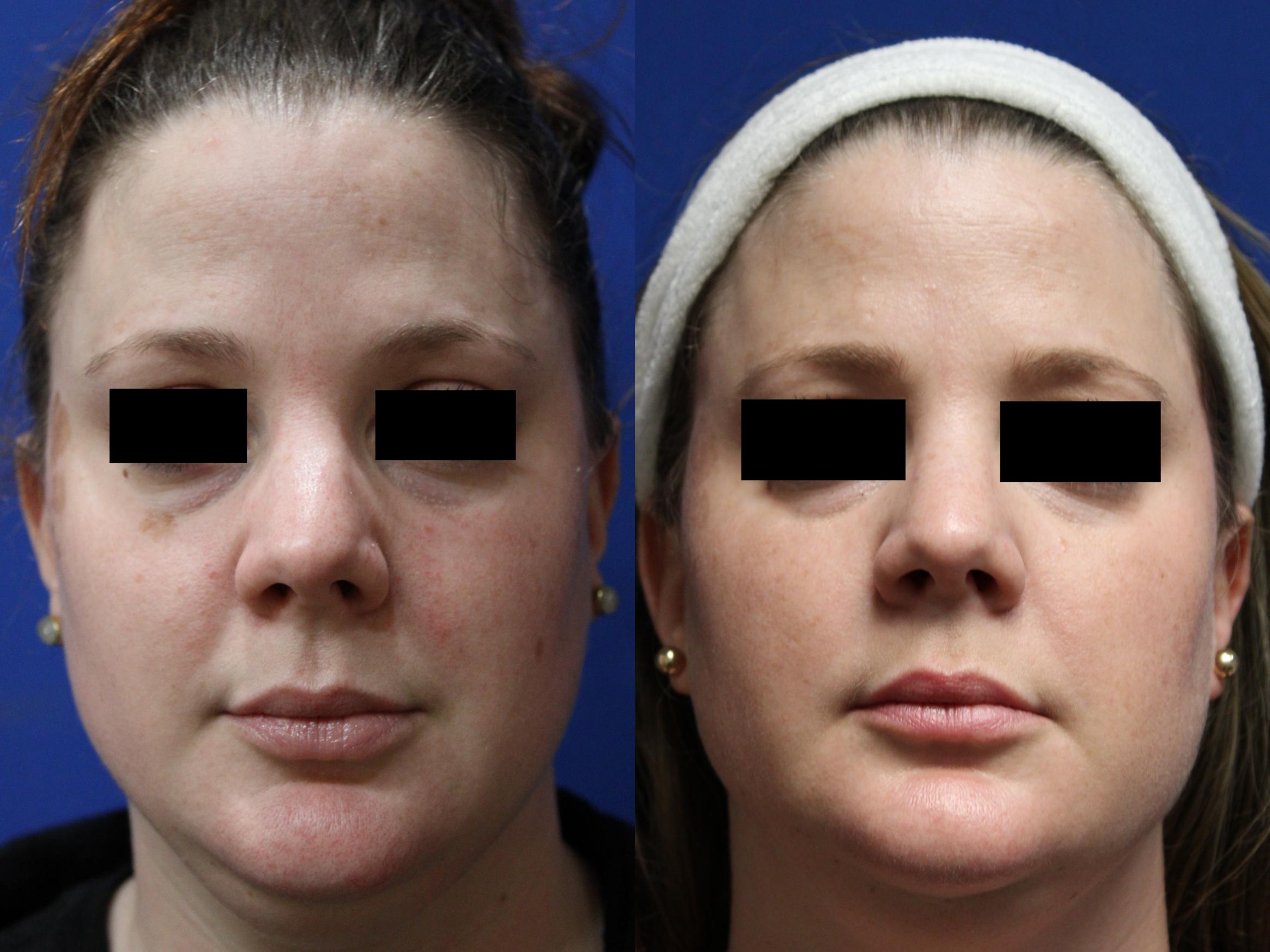 Before & After Pigment Removal Case 436 Front View in Santa Rosa, California