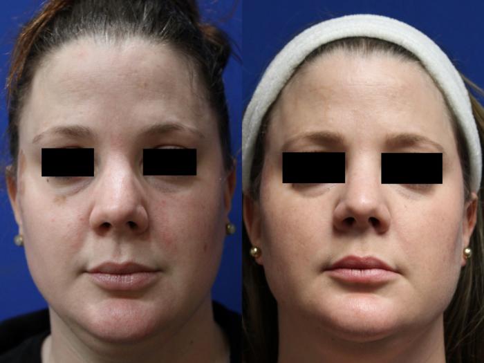 Before & After Pigment Removal Case 436 Front View in Santa Rosa, California