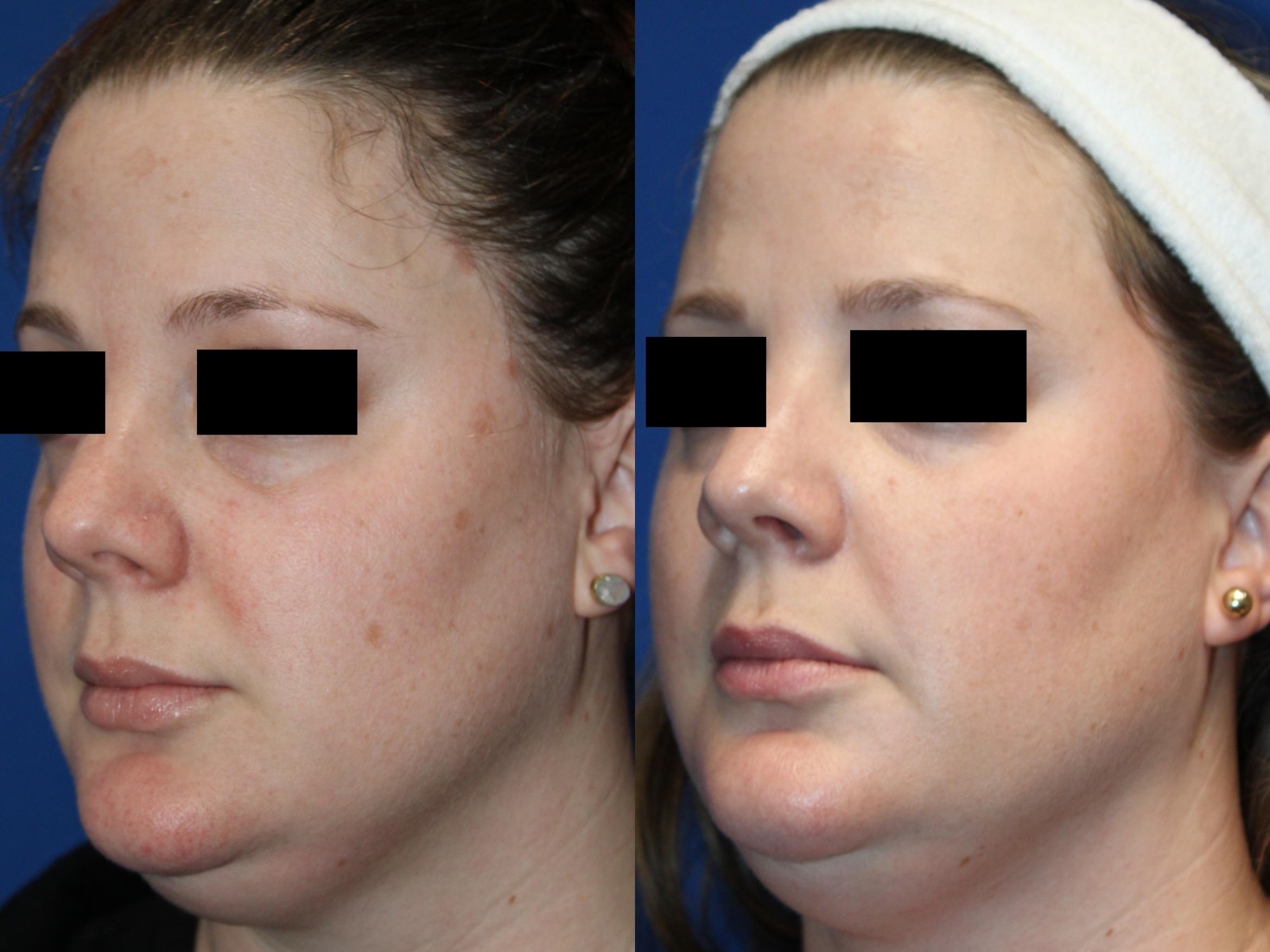 Before & After Pigment Removal Case 436 Right Oblique View in Santa Rosa, California