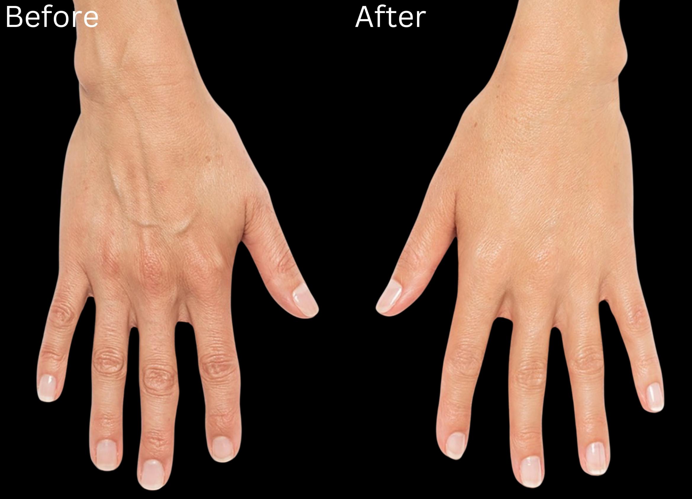 Before & After Radiesse Filler Case 164 View 1 View in Santa Rosa, California