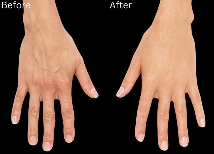 Before & After Radiesse Filler Case 164 View 1 View in Santa Rosa, California