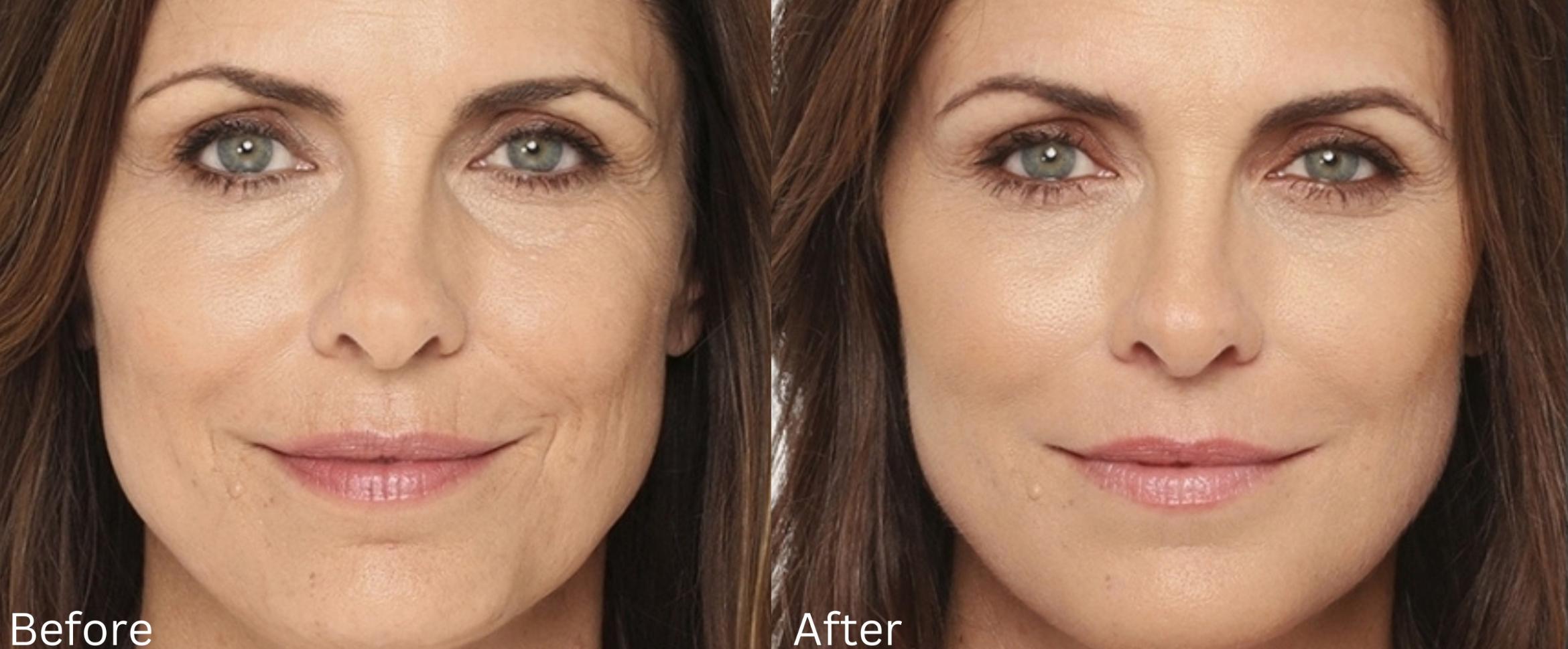 Before & After Radiesse Filler Case 313 View 1 View in Santa Rosa, California